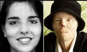 Before and after accident of Jacqueline Saburido's face.